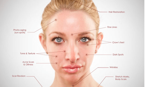 Microneedling Facial